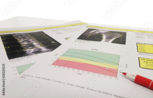 Soft and blurry image Woman's hip bone mass image The graph has a standard point below Therefore diagnosed with osteoporosis  photo