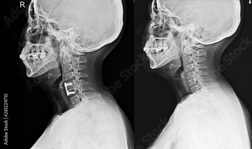 X-ray C-SPINES show post operation internal fixation C4-C5 & C6 with plate & screws red mark and There is hypersignal intensity lesion in the spinal cord at C4 to C6 levels photo