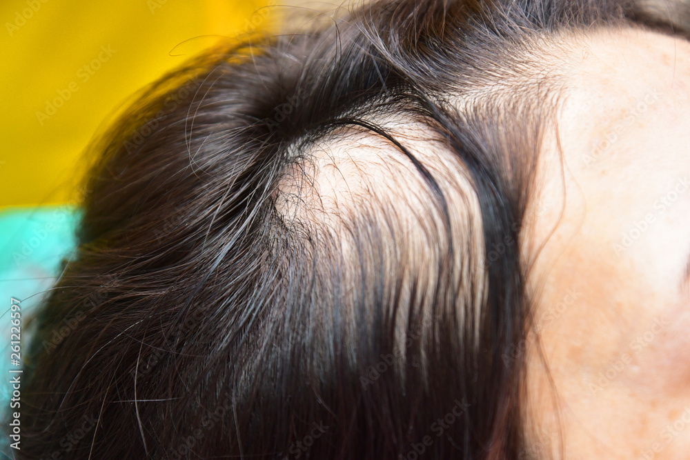 Treatment of baldness with beauty injections. Cosmetologist's hands in gloves make a subcutaneous injection. Treatment of baldness with beauty injections. Cosmetologist's hands in gloves make a subcutaneous injection.