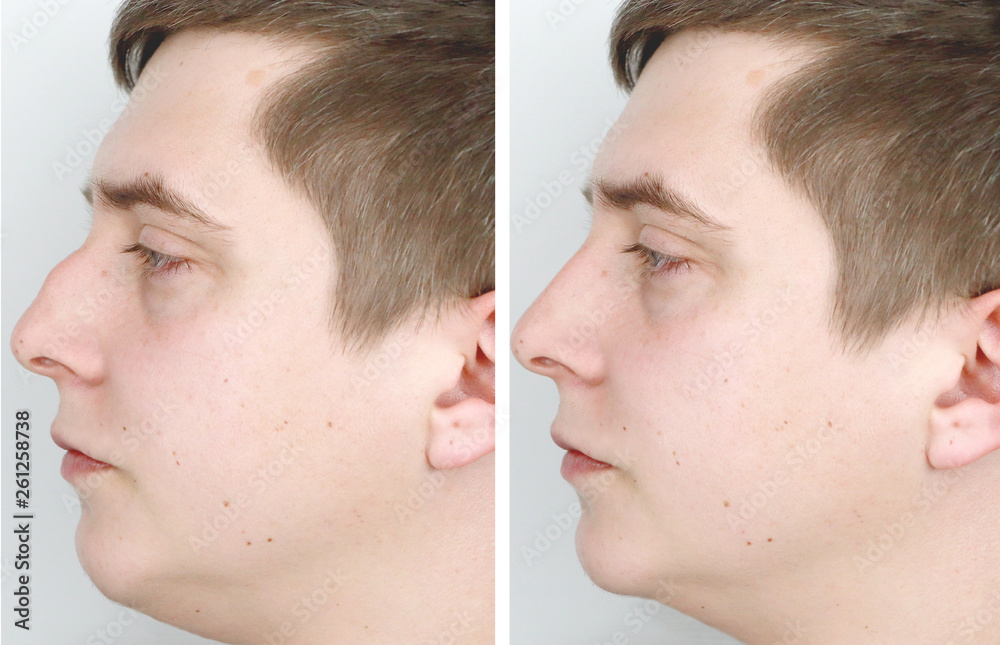 Obraz premium A man at the reception at the plastic surgeon. Before nose surgery, rhinoplasty