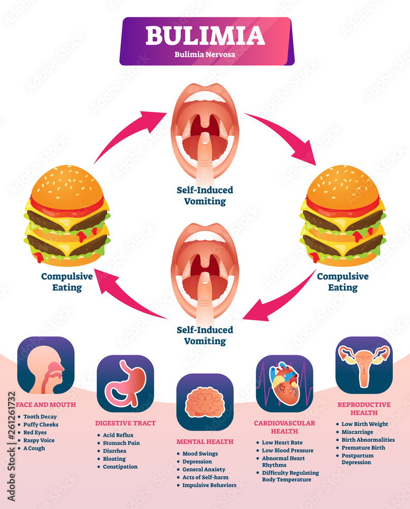 Bulimia vector illustration. Labeled self induced vomiting diagnosis scheme  Stock Vector | Adobe Stock