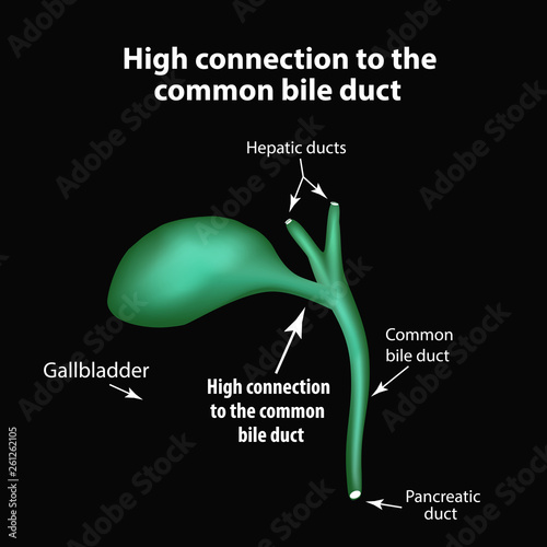 High connection to the common bile duct. Pathology of the gallbladder. Cholecystitis. The structure of the gallbladder. Infographics. Vector illustration photo