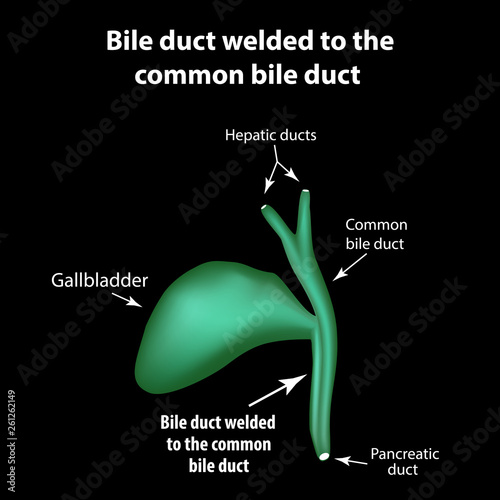 Bile duct welded to the common bile duct. Pathology of the gallbladder. Cholecystitis. The structure of the gallbladder. Infographics. Vector illustration