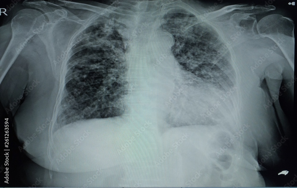 Chest Xray A Female 78 year old finding A 4.2cm cavity at right upper