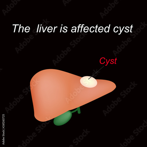 A cyst in the liver. The liver is affected cyst. Vector illustration on a black background