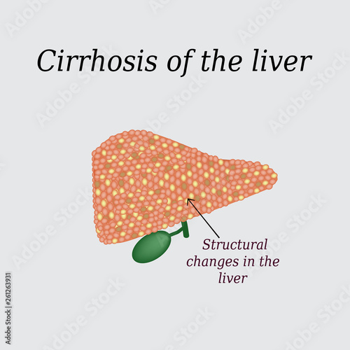 Cirrhosis of the liver. Vector illustration on a gray background photo
