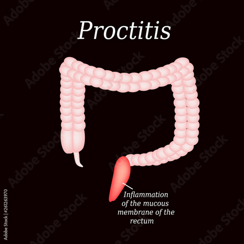 Colon. Proctitis. Vector illustration photo