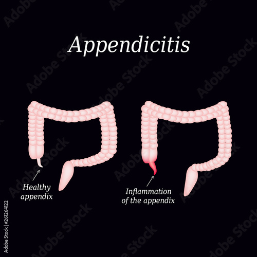 Appendicitis. Inflammation of the appendix. Colon. The illustration on a black background