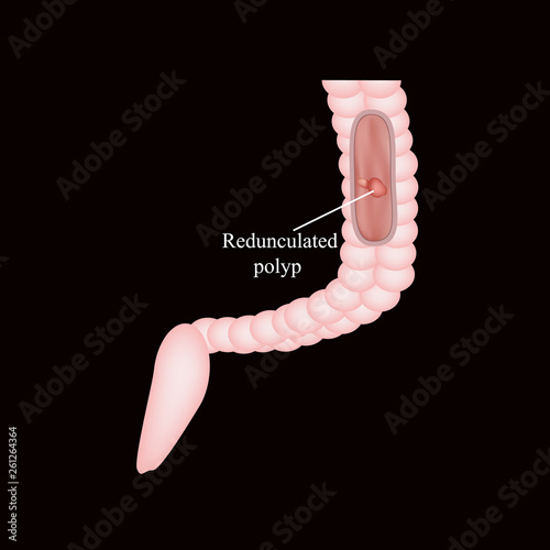 Polyp in the intestine. Polyp in the colon. Vector illustration on a black background