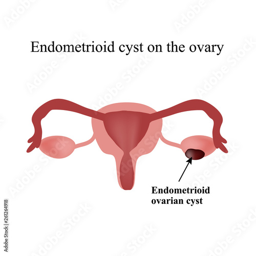 Endometrioid cyst on the ovary. Endometriosis. . Infographics. Vector illustration  isolated background