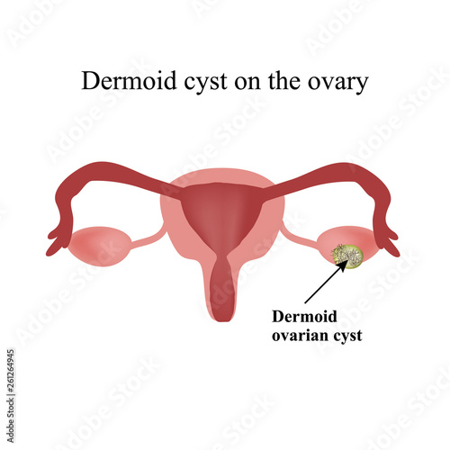 Dermoid cyst on the ovary. . Infographics. Vector illustration  isolated background