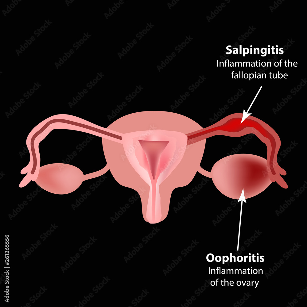 Salpingitis. Inflammation Of The Fallopian Tube. Oophoritis. Inflammation  Of The Ovary. Pelvic Organs. Infographics. Vector Illustration On Isolated  Background. Royalty Free SVG, Cliparts, Vectors, and Stock Illustration.  Image 68281130.