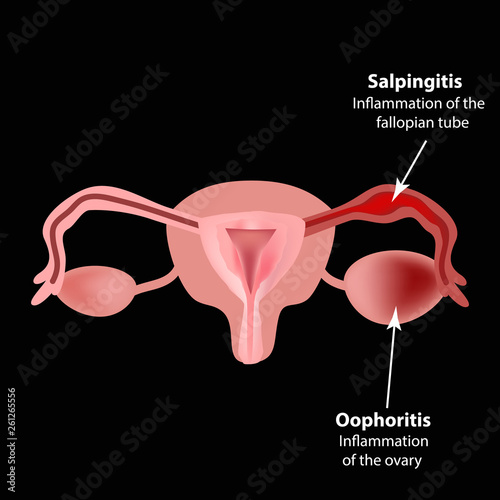 Salpingitis. Inflammation of the fallopian tube. Oophoritis.   the ovary. pelvic organs. Infographics Vector illustration photo