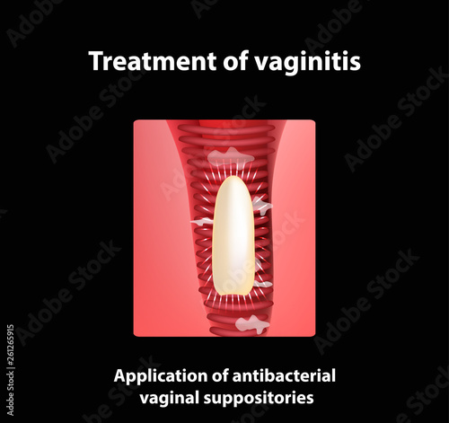 Treatment of vaginitis suppositories. inflammation  the vagina. Infographics. vector illustration