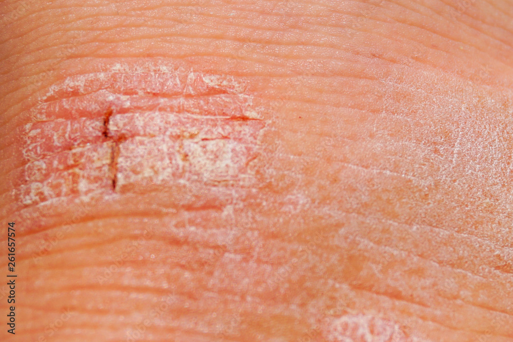 Psoriasis dry red and white irritation on the skin closeup.