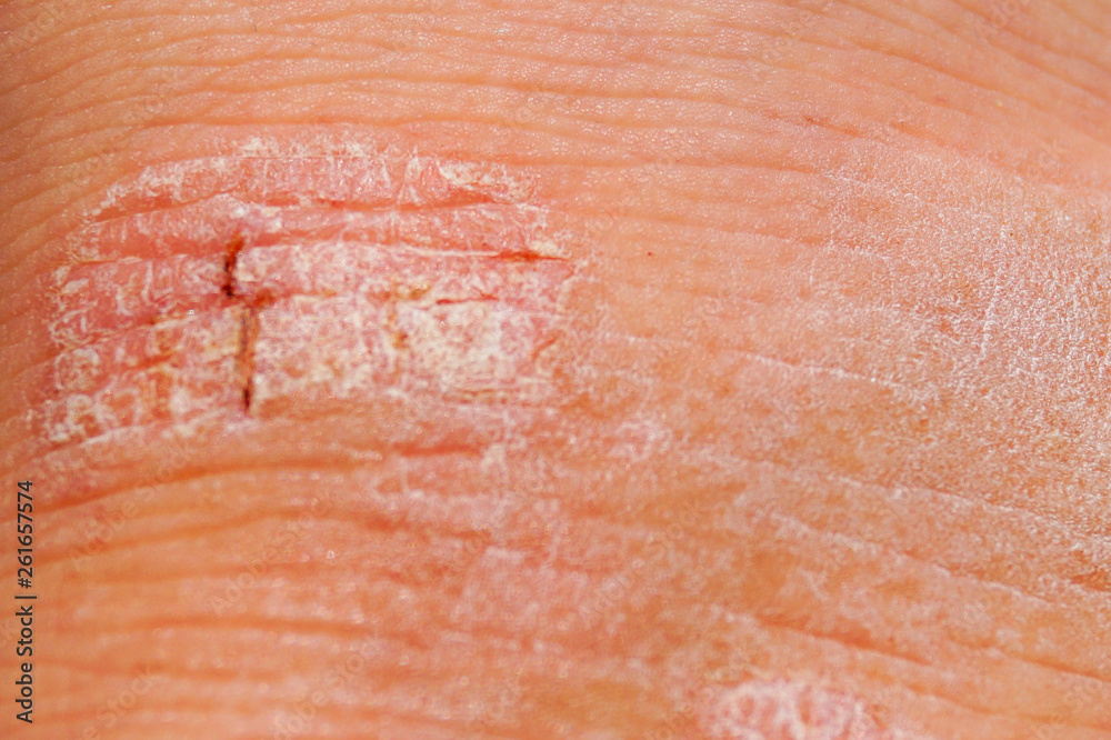Fototapeta premium Psoriasis dry red and white irritation on the skin closeup.