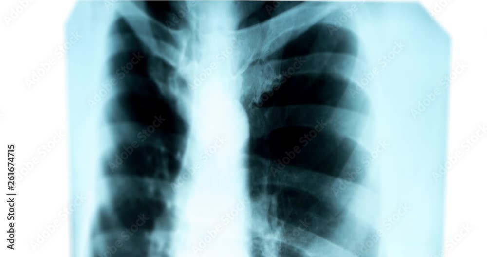 X-ray of the chest on the light screen, scrolling down X-ray of the chest on the light screen, scrolling down