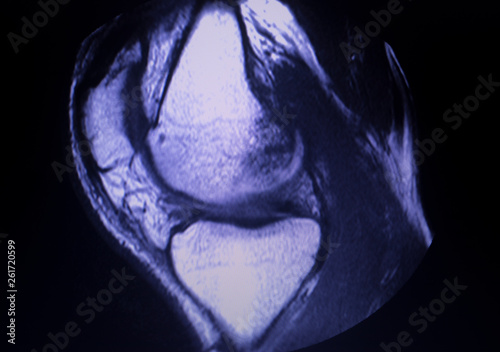 Photography MRI knee meniscus tear scan