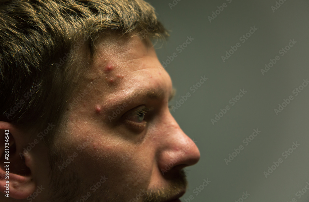 Fototapeta premium acne, problem skin of men
