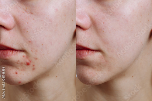 Young woman before and after acne treatment, closeup. Skin care concept photo