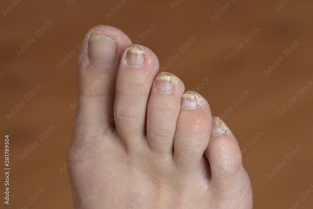 Closeup ingrown nail at the big toe of a man isolated on white background. Closeup ingrown nail at the big toe of a man isolated on white background.