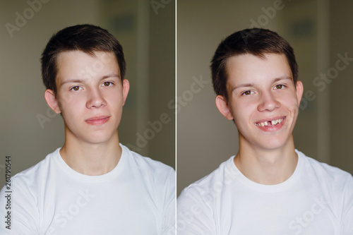 Obraz na płótnie the guy with the broken front tooth