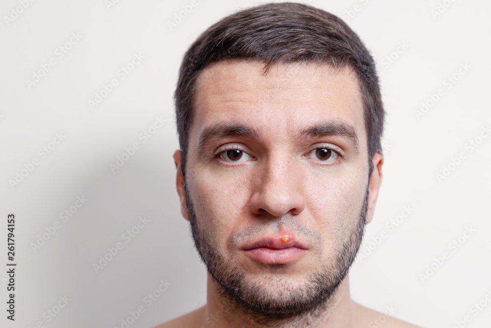 Obraz premium Herpes on lips of the young man. Inflammation of the lip. Beautiful lips infected herpes virus.