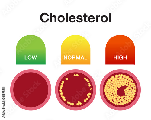 Cholesterol in artery, health risk , vector design