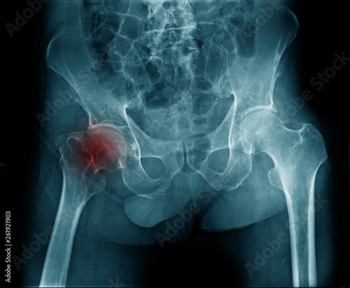 x-ray image of old woman show degenerative change of hip joint, hip avascular necrosis right side of alderly photo