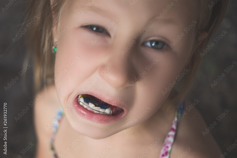 A little girl with crooked teeth shows an orthodontic appliance in her mouth. A little girl with crooked teeth shows an orthodontic appliance in her mouth.
