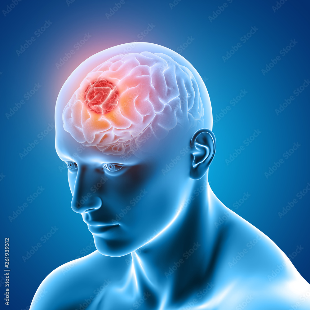 Εκτύπωση καμβά 3D medical image showing male figure with brain tumour