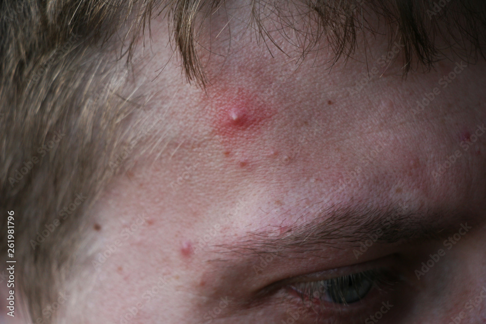 acne, problem skin of men acne, problem skin of men