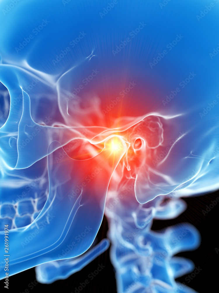 Fototapeta premium 3d rendered medically accurate illustration of the temporomandibuar joint showing pain