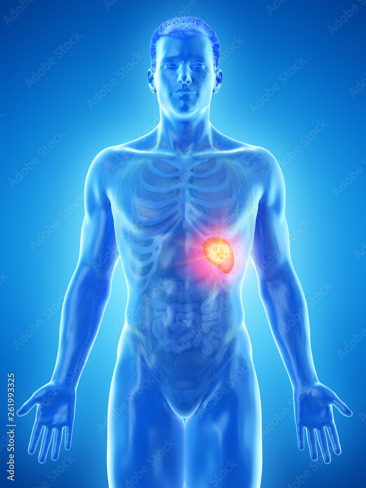 3d rendered medically accurate illustration of a mans spleen tumor 3d rendered medically accurate illustration of a mans spleen tumor