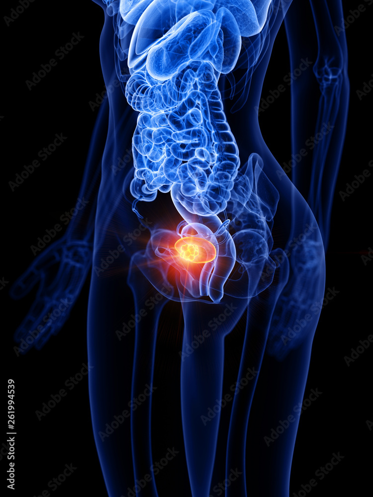 3d rendered medically accurate illustration of a womans bladder tumor 3d rendered medically accurate illustration of a womans bladder tumor