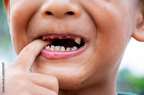 Boy or children have problem with teeth about caries