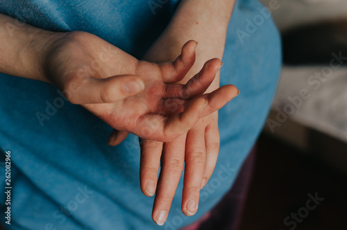 Woman sick hands. Scabies in hands