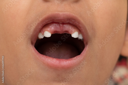 Macro of mouth of a child who has lost two incisors