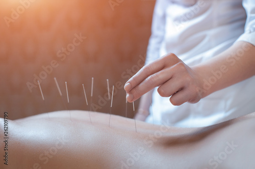 фотографія needle acupuncture procedure;
