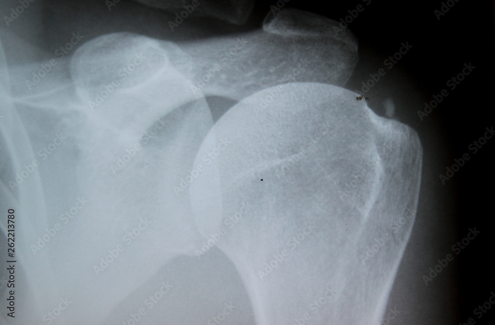 XRay image of calcified shoulder (Tendinosis calcarea) Stock Photo