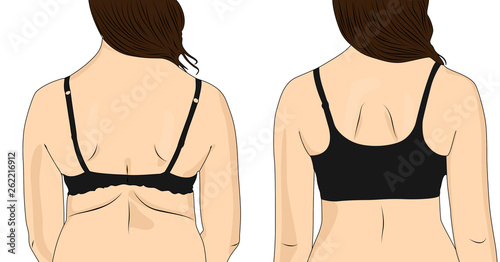 Stubborn Back Fat