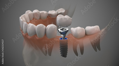 Tooth human implant. On1 concept. Dental prosthetic innovation. 3d illustration. photo