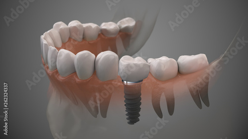 Tooth human implant. On1 concept. Dental prosthetic innovation. 3d illustration.