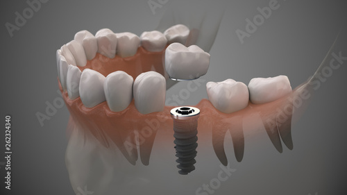Tooth human implant. On1 concept. Dental prosthetic innovation. 3d illustration.