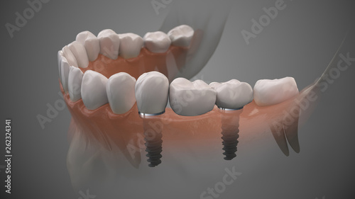Tooth bridge human implant. Dental prosthetic innovation. 3d illustration.