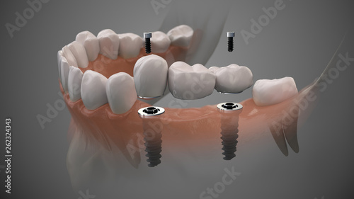 Tooth bridge human implant. Dental prosthetic innovation. 3d illustration.