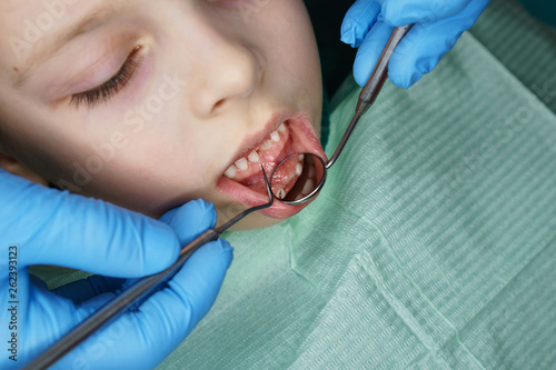 Dentist hands with medical instruments. Little girl sits in dental chair with her mouth open. Routine inspection of milk teeth.