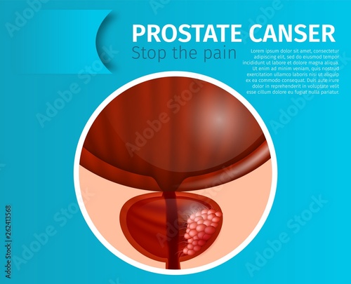 Prostate Cancer. Stop the Pain Urological Banner.