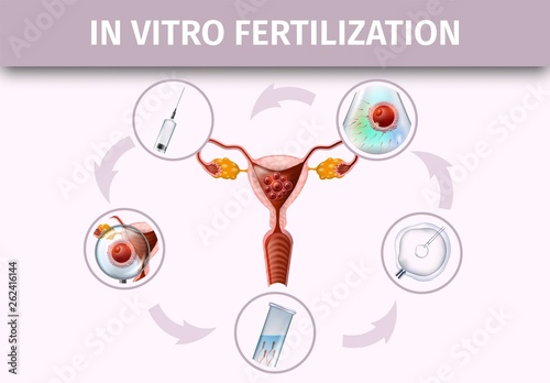 Human In Vitro Fertilization Stages Infographic. photo