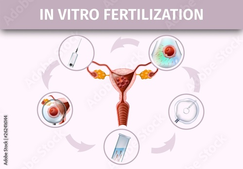 Human In Vitro Fertilization Stages Infographic.